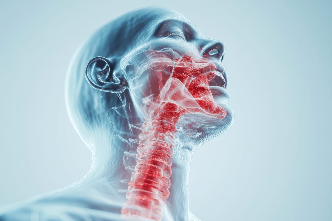 A 3D image illustrating a collapsed airway caused by muscle relaxation during sleep apnea